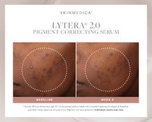 Load image into Gallery viewer, A female, age 47, who used SkinMedica Lytera 2.0 for 4 weeks and significantly reduced the blemishes on her face.