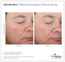 Load image into Gallery viewer, Before and after photos of a female, age 45, who used the SkinMedica Retinol Complex 1.0 for 12 weeks. Her skin appears healthier with less blemishes.